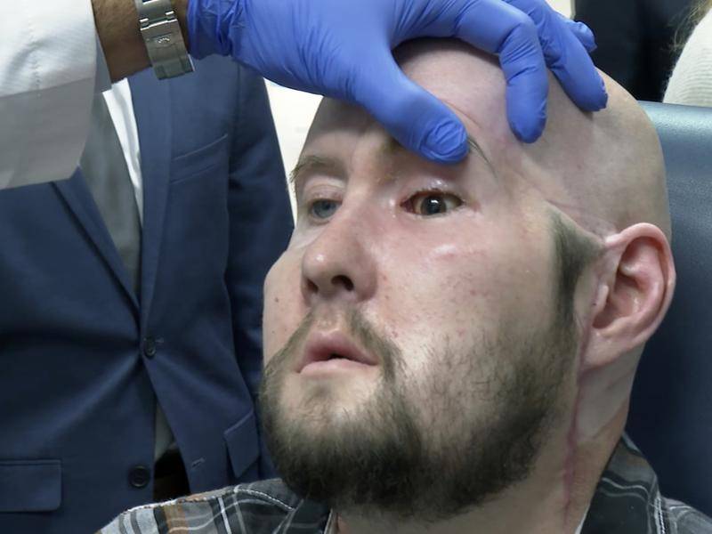 US surgeons perform first-ever whole eye transplant